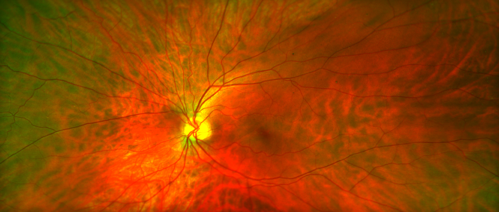 Vitreous Separation - Retina Vitreous Consultants, Inc