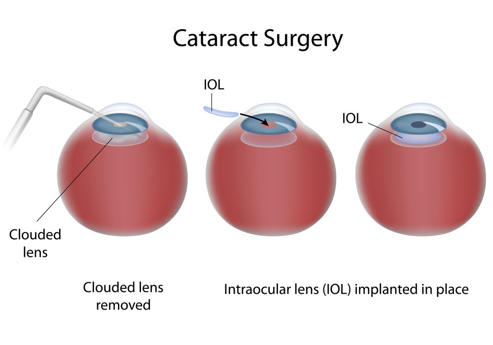Cataracts Surgery Retina Vitreous Consultants, Inc