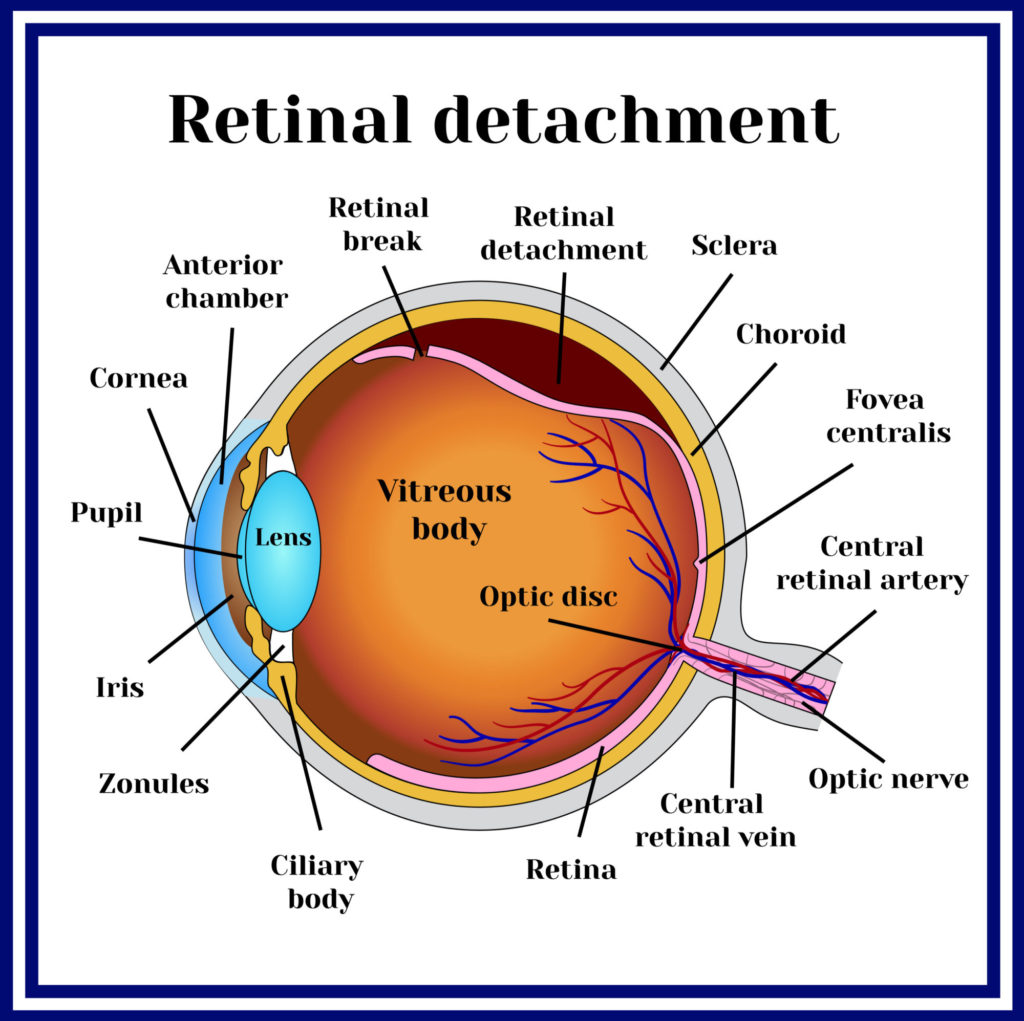 detached retina surgery recovery film on eye