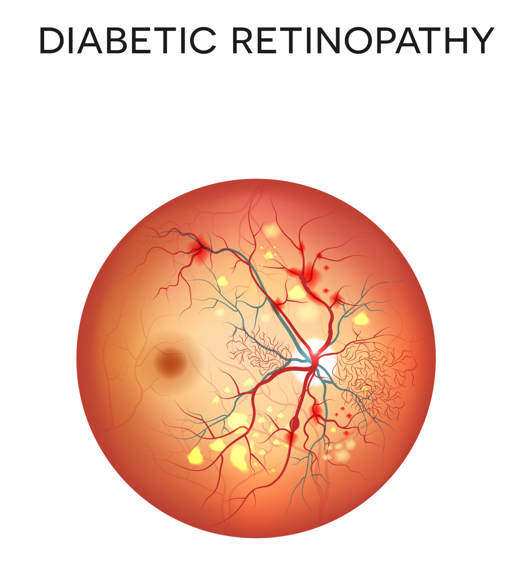 Nursing Care For Diabetic Retinopathy